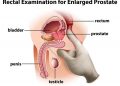 Can Enlarged Prostate Cause Erectile Dysfunction?