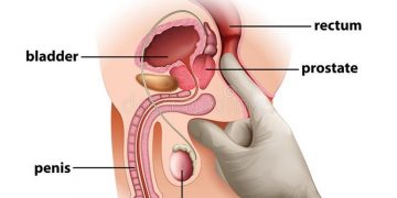 Can Enlarged Prostate Cause Erectile Dysfunction?